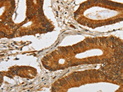 The image on the left is immunohistochemistry of paraffin-embedded Human colon cancer tissue using the antibody Antibody) at dilution 1/80, on the right is treated with fusion protein. (Original magnification: ×200)Rabbit anti-Human SPHK2 Polyclonal Antibody