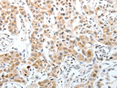 The image on the left is immunohistochemistry of paraffin-embedded Human lung cancer tissue using SLC22A3 Antibody(SLC22A3 Antibody) at dilution 1/40, on the right is treated with synthetic peptide. (Original magnification: ×200)Rabbit anti-Human SLC22A3 Polyclonal Antibody