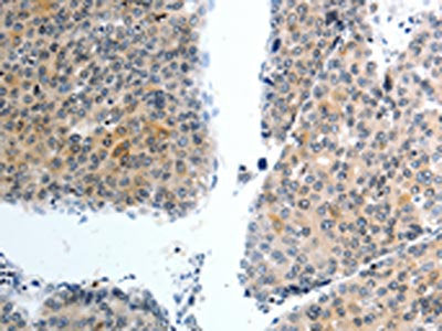 The image on the left is immunohistochemistry of paraffin-embedded Human liver cancer tissue using the antibody Antibody) at dilution 1/40, on the right is treated with synthetic peptide. (Original magnification: ×200)Rabbit anti-Human SLC22A3 Polyclonal Antibody