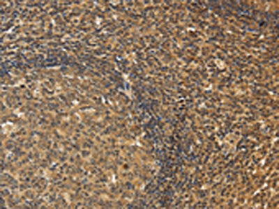 The image on the left is immunohistochemistry of paraffin-embedded Human tonsil tissue using CXXC5 Antibody(CXXC5 Antibody) at dilution 1/20, on the right is treated with fusion protein. (Original magnification: ×200)Rabbit anti-Human CXXC5 Polyclonal Antibody