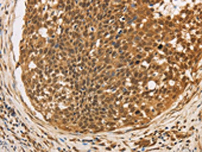 The image on the left is immunohistochemistry of paraffin-embedded Human cervical cancer tissue using the antibody Antibody) at dilution 1/20, on the right is treated with fusion protein. (Original magnification: ×200)Rabbit anti-Human CXXC5 Polyclonal Antibody