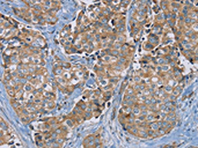 The image on the left is immunohistochemistry of paraffin-embedded Human breast cancer tissue using PUS10 Antibody(PUS10 Antibody) at dilution 1/40, on the right is treated with synthetic peptide. (Original magnification: ×200)Rabbit anti-Human PUS10 Polyclonal Antibody