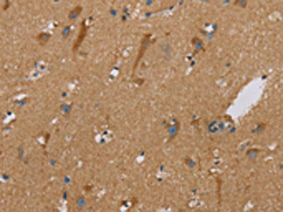 The image on the left is immunohistochemistry of paraffin-embedded Human brain tissue using the antibody Antibody) at dilution 1/40, on the right is treated with synthetic peptide. (Original magnification: ×200)Rabbit anti-Human PUS10 Polyclonal Antibody