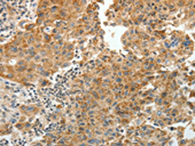 The image on the left is immunohistochemistry of paraffin-embedded Human lung cancer tissue using PRKCA Antibody(PRKCA Antibody) at dilution 1/10, on the right is treated with fusion protein. (Original magnification: ×200)Rabbit anti-Human PRKCA Polyclonal Antibody