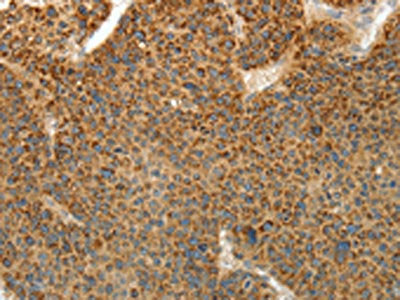 The image on the left is immunohistochemistry of paraffin-embedded Human liver cancer tissue using the antibody Antibody) at dilution 1/10, on the right is treated with fusion protein. (Original magnification: ×200)Rabbit anti-Human PRKCA Polyclonal Antibody
