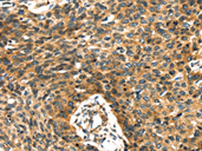 The image on the left is immunohistochemistry of paraffin-embedded Human esophagus cancer tissue using PRSS50 Antibody(PRSS50 Antibody) at dilution 1/30, on the right is treated with synthetic peptide. (Original magnification: ×200)Rabbit anti-Human PRSS50 Polyclonal Antibody