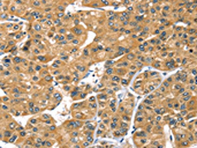 The image on the left is immunohistochemistry of paraffin-embedded Human liver cancer tissue using the antibody Antibody) at dilution 1/30, on the right is treated with synthetic peptide. (Original magnification: ×200)Rabbit anti-Human PRSS50 Polyclonal Antibody