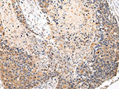 The image on the left is immunohistochemistry of paraffin-embedded Human esophagus cancer tissue using VPS37A Antibody(VPS37A Antibody) at dilution 1/20, on the right is treated with fusion protein. (Original magnification: ×200)Rabbit anti-Human VPS37A Polyclonal Antibody