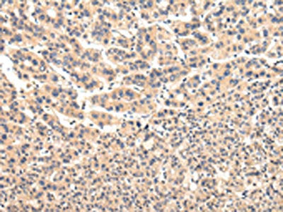 The image on the left is immunohistochemistry of paraffin-embedded Human liver cancer tissue using the antibody Antibody) at dilution 1/20, on the right is treated with fusion protein. (Original magnification: ×200)Rabbit anti-Human VPS37A Polyclonal Antibody