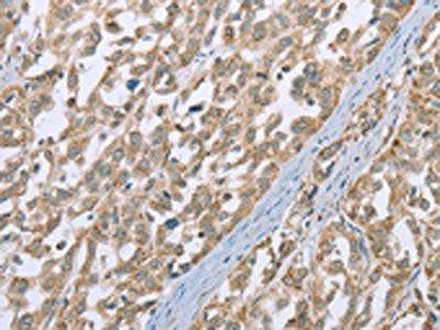 The image on the left is immunohistochemistry of paraffin-embedded Human esophagus cancer tissue using the antibody Antibody) at dilution 1/35, on the right is treated with fusion protein. (Original magnification: ×200)Rabbit anti-Human ECHS1 Polyclonal Antibody