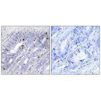 Immunohistochemistry analysis of paraffin-embedded human colon carcinoma tissue using Nuclear Receptor NR4A1 (Ab-351) antibody.Rabbit anti-Human NR4A1 Polyclonal Antibody