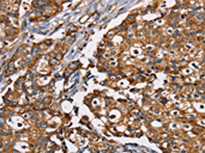 The image on the left is immunohistochemistry of paraffin-embedded Human breast cancer tissue using NDUFS1 Antibody(NDUFS1 Antibody) at dilution 1/35, on the right is treated with fusion protein. (Original magnification: ×200)Rabbit anti-Human NDUFS1 Polyclonal Antibody