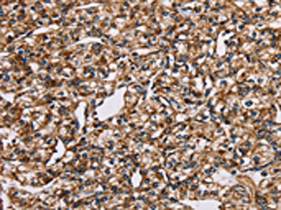 The image on the left is immunohistochemistry of paraffin-embedded Human prostate cancer tissue using the antibody Antibody) at dilution 1/35, on the right is treated with fusion protein. (Original magnification: ×200)Rabbit anti-Human NDUFS1 Polyclonal Antibody