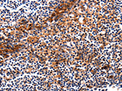 The image on the left is immunohistochemistry of paraffin-embedded Human tonsil tissue using HP Antibody(HP Antibody) at dilution 1/25, on the right is treated with fusion protein. (Original magnification: ×200)Rabbit anti-Human HP Polyclonal Antibody