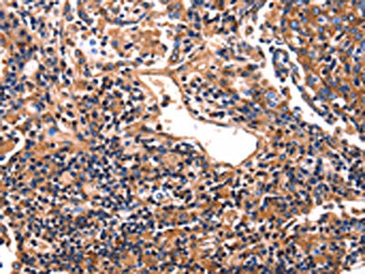 The image on the left is immunohistochemistry of paraffin-embedded Human lung cancer tissue using the antibody Antibody) at dilution 1/25, on the right is treated with fusion protein. (Original magnification: ×200)Rabbit anti-Human HP Polyclonal Antibody