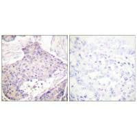 Immunohistochemical analysis of paraffin-embedded human breast carcinoma tissue using CARD6 antibody.
