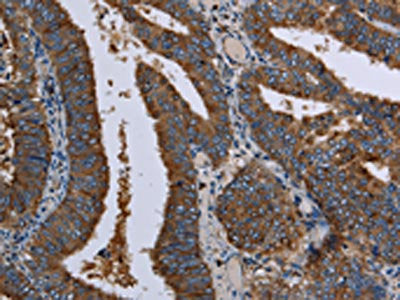 The image on the left is immunohistochemistry of paraffin-embedded Human colon cancer tissue using LZTFL1 Antibody(LZTFL1 Antibody) at dilution 1/30, on the right is treated with fusion protein. (Original magnification: ×200)
