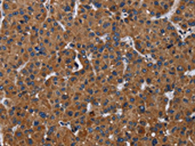 The image on the left is immunohistochemistry of paraffin-embedded Human liver cancer tissue using the antibody Antibody) at dilution 1/30, on the right is treated with fusion protein. (Original magnification: ×200)