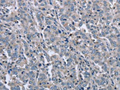 The image on the left is immunohistochemistry of paraffin-embedded Human liver cancer tissue using FAR2 Antibody(FAR2 Antibody) at dilution 1/50, on the right is treated with fusion protein. (Original magnification: ×200)Rabbit anti-Human FAR2 Polyclonal Antibody