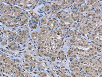 The image on the left is immunohistochemistry of paraffin-embedded Human thyroid cancer tissue using the antibody Antibody) at dilution 1/50, on the right is treated with fusion protein. (Original magnification: ×200)Rabbit anti-Human FAR2 Polyclonal Antibody