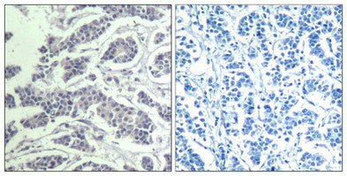 Immunohistochemical analysis of paraffin-embedded human breast carcinoma tissue using AKT1/AKT2/AKT3(Phospho-Tyr315/316/312) Antibody(left) or the same antibody preincubated with blocking peptide(right).Rabbit anti-Human AKT1/AKT2/AKT3 Polyclonal Antibody