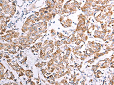 The image on the left is immunohistochemistry of paraffin-embedded Human breast cancer tissue using ATPIF1 Antibody(ATPIF1 Antibody) at dilution 1/50, on the right is treated with fusion protein. (Original magnification: ×200)