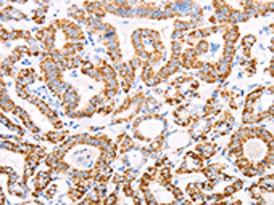 The image on the left is immunohistochemistry of paraffin-embedded Human thyroid cancer tissue using the antibody Antibody) at dilution 1/50, on the right is treated with fusion protein. (Original magnification: ×200)