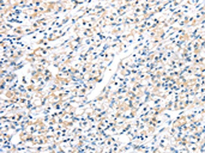 The image on the left is immunohistochemistry of paraffin-embedded Human prostate cancer tissue using HSD11B2 Antibody(HSD11B2 Antibody) at dilution 1/20, on the right is treated with synthetic peptide. (Original magnification: ×200)Rabbit anti-Human HSD11B2 Polyclonal Antibody