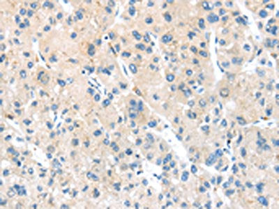The image on the left is immunohistochemistry of paraffin-embedded Human liver cancer tissue using the antibody Antibody) at dilution 1/20, on the right is treated with synthetic peptide. (Original magnification: ×200)Rabbit anti-Human HSD11B2 Polyclonal Antibody