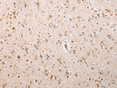 The image on the left is immunohistochemistry of paraffin-embedded Human brain tissue using UQCRC2 Antibody(UQCRC2 Antibody) at dilution 1/25, on the right is treated with fusion protein. (Original magnification: ×200)Rabbit anti-Human UQCRC2 Polyclonal Antibody
