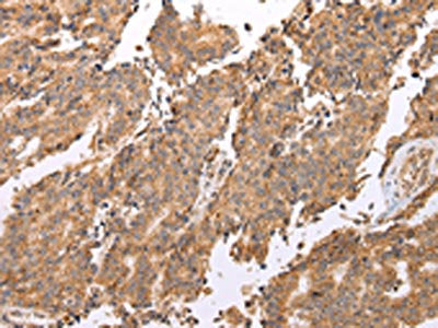 The image on the left is immunohistochemistry of paraffin-embedded Human prostate cancer tissue using the antibody Antibody) at dilution 1/25, on the right is treated with fusion protein. (Original magnification: ×200)Rabbit anti-Human UQCRC2 Polyclonal Antibody