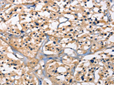 The image on the left is immunohistochemistry of paraffin-embedded Human thyroid cancer tissue using the antibody Antibody) at dilution 1/15, on the right is treated with fusion protein. (Original magnification: ×200)