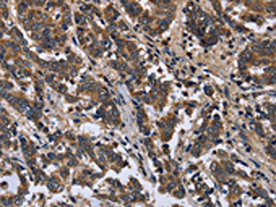 The image is immunohistochemistry of paraffin-embedded Human liver cancer tissue using the antibody Antibody) at dilution 1/50. (Original magnification: ×200)Rabbit anti-Human FRK Polyclonal Antibody