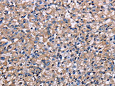 The image on the left is immunohistochemistry of paraffin-embedded Human prostate cancer tissue using NIT1 Antibody(NIT1 Antibody) at dilution 1/50, on the right is treated with fusion protein. (Original magnification: ×200)Rabbit anti-Human NIT1 Polyclonal Antibody