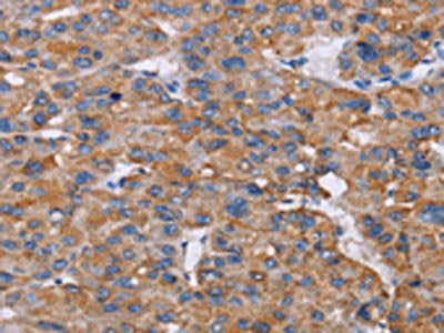 The image on the left is immunohistochemistry of paraffin-embedded Human liver cancer tissue using the antibody Antibody) at dilution 1/50, on the right is treated with fusion protein. (Original magnification: ×200)Rabbit anti-Human NIT1 Polyclonal Antibody