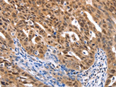 The image on the left is immunohistochemistry of paraffin-embedded Human ovarian cancer tissue using MAP2K1 Antibody(MAP2K1 Antibody) at dilution 1/25, on the right is treated with synthetic peptide. (Original magnification: ×200)