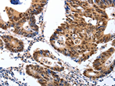 The image on the left is immunohistochemistry of paraffin-embedded Human colon cancer tissue using the antibody Antibody) at dilution 1/25, on the right is treated with synthetic peptide. (Original magnification: ×200)