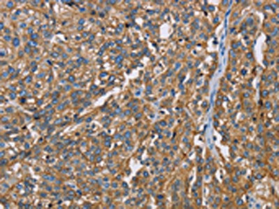 The image on the left is immunohistochemistry of paraffin-embedded Human esophagus cancer tissue using the antibody Antibody) at dilution 1/60, on the right is treated with fusion protein. (Original magnification: ×200)