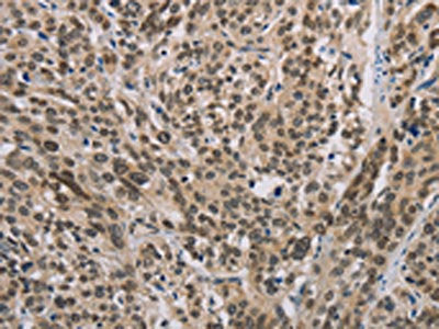 The image on the left is immunohistochemistry of paraffin-embedded Human esophagus cancer tissue using IRF9 Antibody(IRF9 Antibody) at dilution 1/50, on the right is treated with fusion protein. (Original magnification: ×200)
