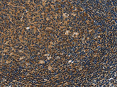 The image on the left is immunohistochemistry of paraffin-embedded Human tonsil tissue using the antibody Antibody) at dilution 1/50, on the right is treated with fusion protein. (Original magnification: ×200)