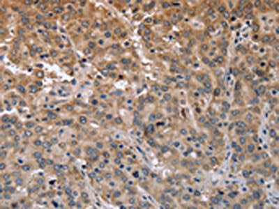 The image on the left is immunohistochemistry of paraffin-embedded Human liver cancer tissue using MAPRE3 Antibody(ECE1 Antibody) at dilution 1/50, on the right is treated with fusion protein. (Original magnification: ×200)