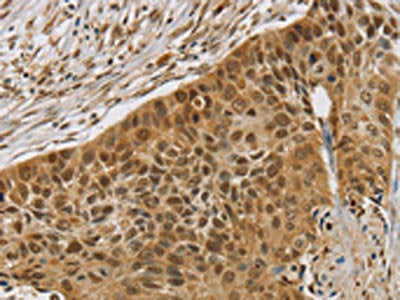 The image on the left is immunohistochemistry of paraffin-embedded Human esophagus cancer tissue using SMC6 Antibody(SMC6 Antibody) at dilution 1/30, on the right is treated with synthetic peptide. (Original magnification: ×200)Rabbit anti-Human SMC6 Polyclonal Antibody