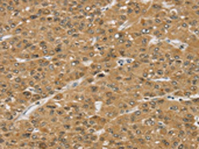 The image on the left is immunohistochemistry of paraffin-embedded Human liver cancer tissue using the antibody Antibody) at dilution 1/30, on the right is treated with synthetic peptide. (Original magnification: ×200)Rabbit anti-Human SMC6 Polyclonal Antibody