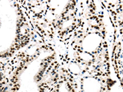 The image on the left is immunohistochemistry of paraffin-embedded Human thyroid cancer tissue using DDX39B Antibody(DDX39B Antibody) at dilution 1/40, on the right is treated with synthetic peptide. (Original magnification: ×200)Rabbit anti-Human DDX39B Polyclonal Antibody