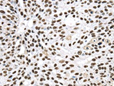The image on the left is immunohistochemistry of paraffin-embedded Human breast cancer tissue using the antibody Antibody) at dilution 1/40, on the right is treated with synthetic peptide. (Original magnification: ×200)Rabbit anti-Human DDX39B Polyclonal Antibody