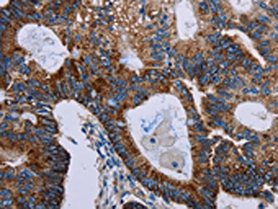 The image on the left is immunohistochemistry of paraffin-embedded Human colon cancer tissue using F11R Antibody(F11R Antibody) at dilution 1/40, on the right is treated with fusion protein. (Original magnification: ×200)Rabbit anti-Human F11R Polyclonal Antibody