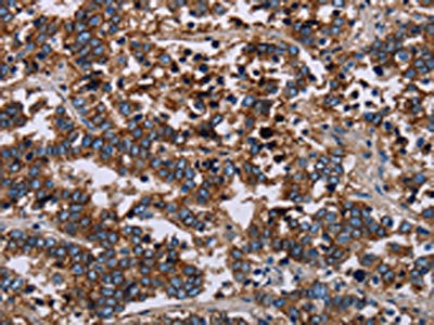 The image on the left is immunohistochemistry of paraffin-embedded Human liver cancer tissue using the antibody Antibody) at dilution 1/40, on the right is treated with fusion protein. (Original magnification: ×200)Rabbit anti-Human F11R Polyclonal Antibody
