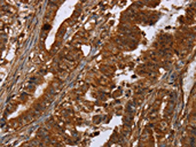The image on the left is immunohistochemistry of paraffin-embedded Human esophagus cancer tissue using POU6F2 Antibody(POU6F2 Antibody) at dilution 1/30, on the right is treated with synthetic peptide. (Original magnification: ×200)Rabbit anti-Human POU6F2 Polyclonal Antibody