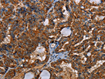 The image on the left is immunohistochemistry of paraffin-embedded Human thyroid cancer tissue using the antibody Antibody) at dilution 1/30, on the right is treated with synthetic peptide. (Original magnification: ×200)Rabbit anti-Human POU6F2 Polyclonal Antibody