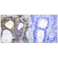 Immunohistochemistry analysis of paraffin-embedded human colon carcinoma tissue using Collagen I α2 antibody.Rabbit anti-Human COL1A2 Polyclonal Antibody